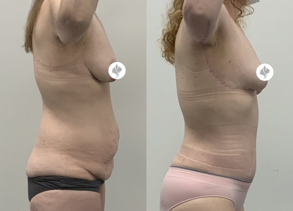 This is one of our beautiful tummy tuck patient #14