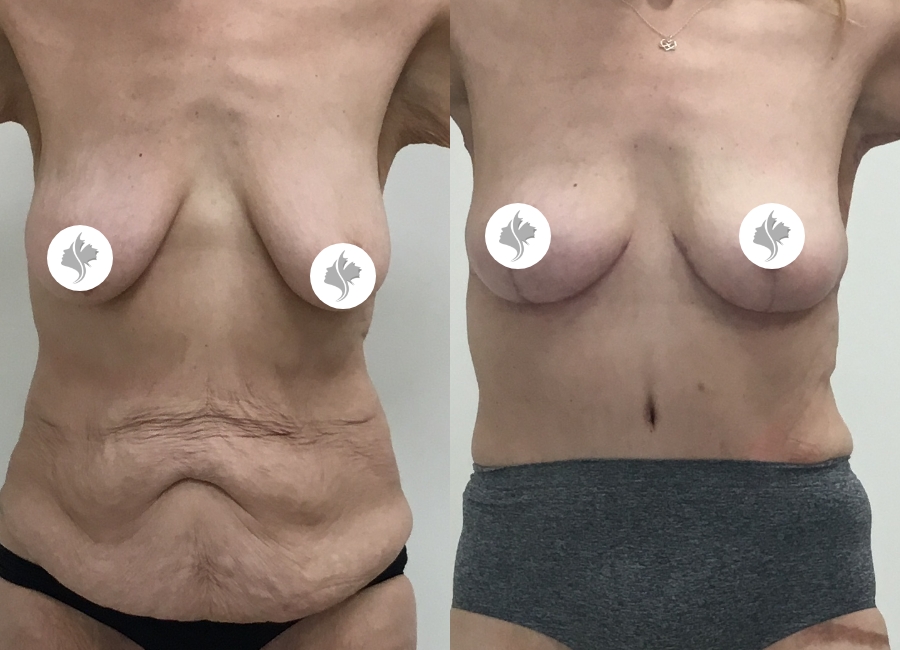 This is one of our beautiful tummy tuck patient 32