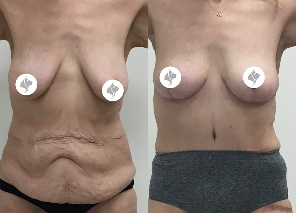 This is one of our beautiful tummy tuck patient #32
