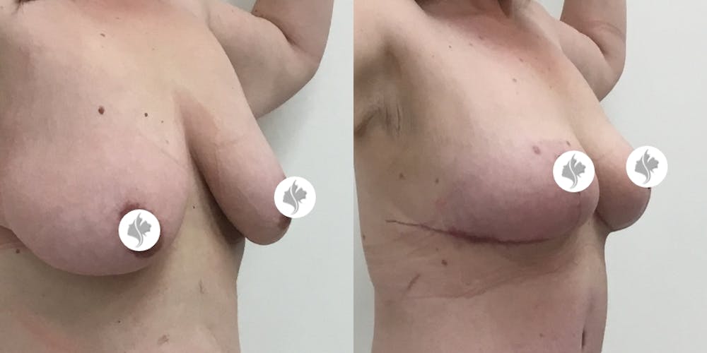 This is one of our beautiful breast asymmetry correction patient #4