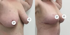 This is one of our beautiful breast reduction patient 30