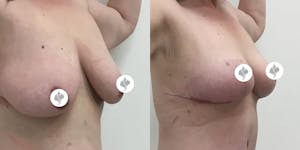 This is one of our beautiful breast asymmetry correction patient 4