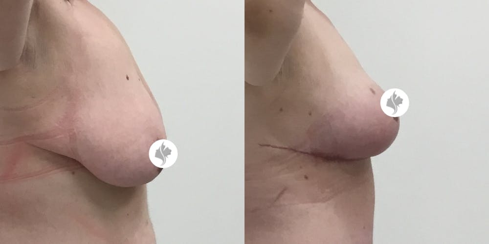 This is one of our beautiful breast asymmetry correction patient #4