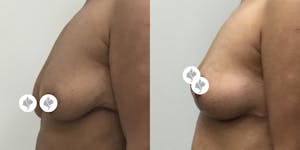 This is one of our beautiful breast reduction patient 32