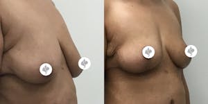 This is one of our beautiful breast reduction patient 32