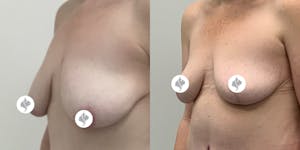 This is one of our beautiful breast reduction patient 33
