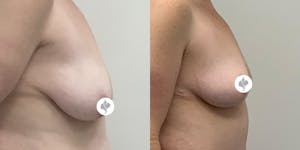 This is one of our beautiful breast reduction patient 33