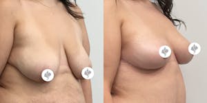This is one of our beautiful breast reduction patient 34