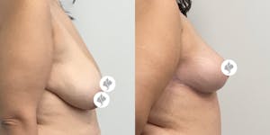 This is one of our beautiful breast reduction patient 34