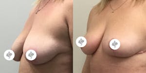 This is one of our beautiful breast reduction patient 1