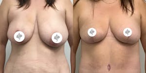 This is one of our beautiful breast asymmetry correction patient 11