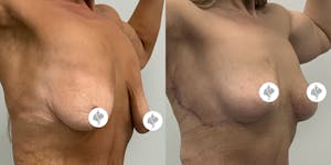 This is one of our beautiful breast reduction patient 37