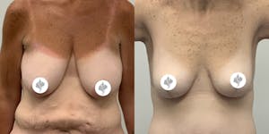 This is one of our beautiful breast reduction patient 38