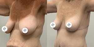 This is one of our beautiful breast reduction patient 38