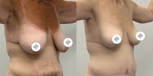 This is one of our beautiful breast reduction patient 38
