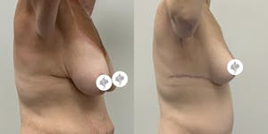 This is one of our beautiful breast reduction patient 38