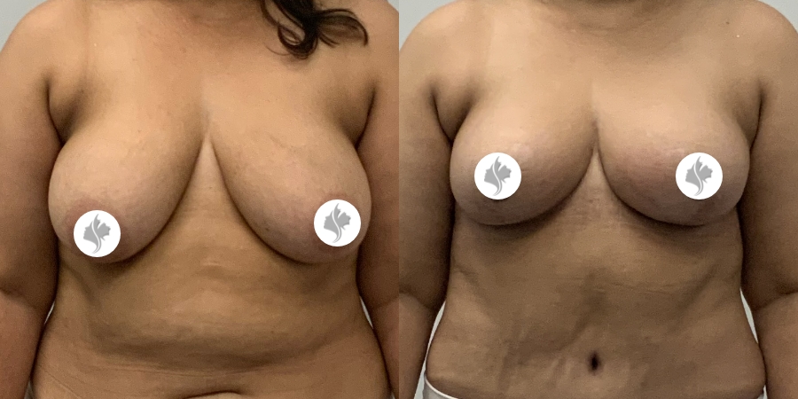 This is one of our beautiful breast reduction patient 39