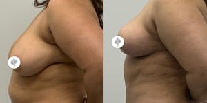 This is one of our beautiful breast reduction patient 39