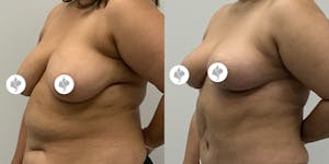 This is one of our beautiful breast reduction patient 39