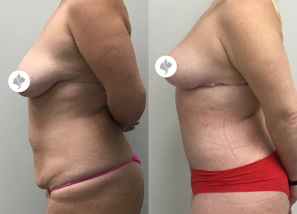 This is one of our beautiful tummy tuck patient #4