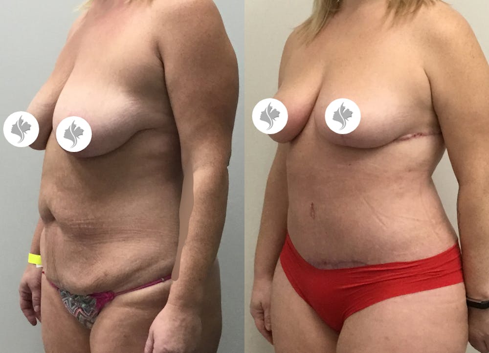 This is one of our beautiful tummy tuck patient #4