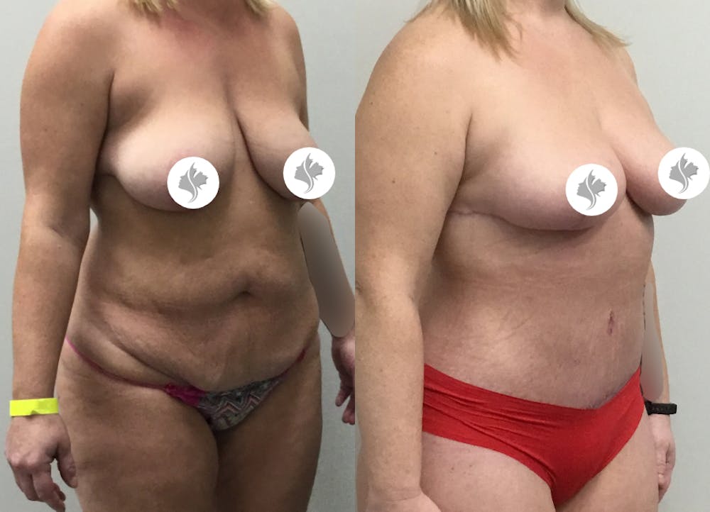 This is one of our beautiful tummy tuck patient #4