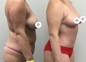 This is one of our beautiful mommy makeover patient 24
