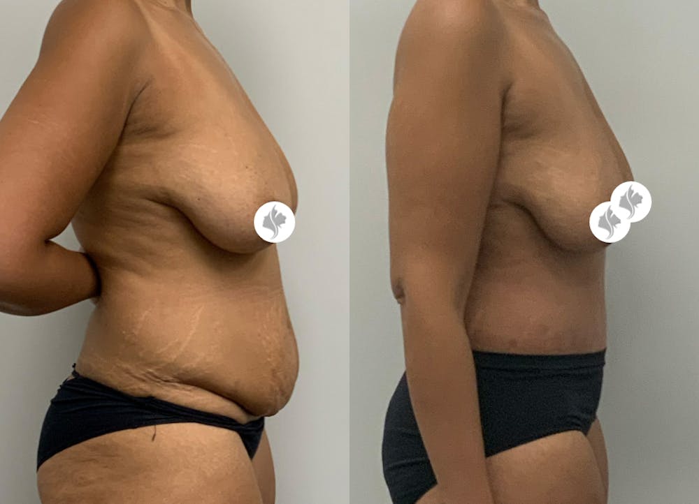 This is one of our beautiful tummy tuck patient #15