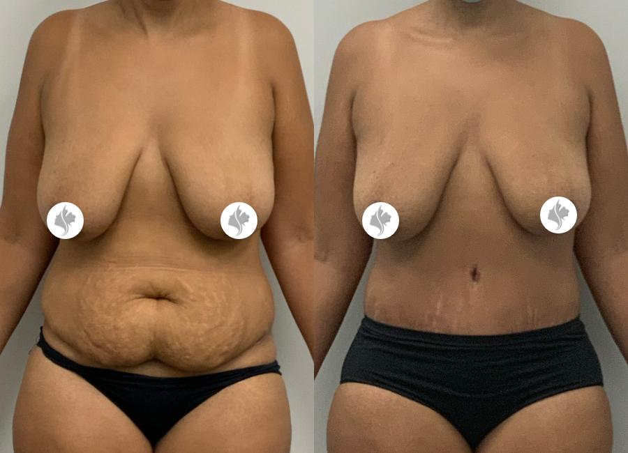 This is one of our beautiful tummy tuck patient 20