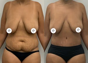 This is one of our beautiful tummy tuck patient 15