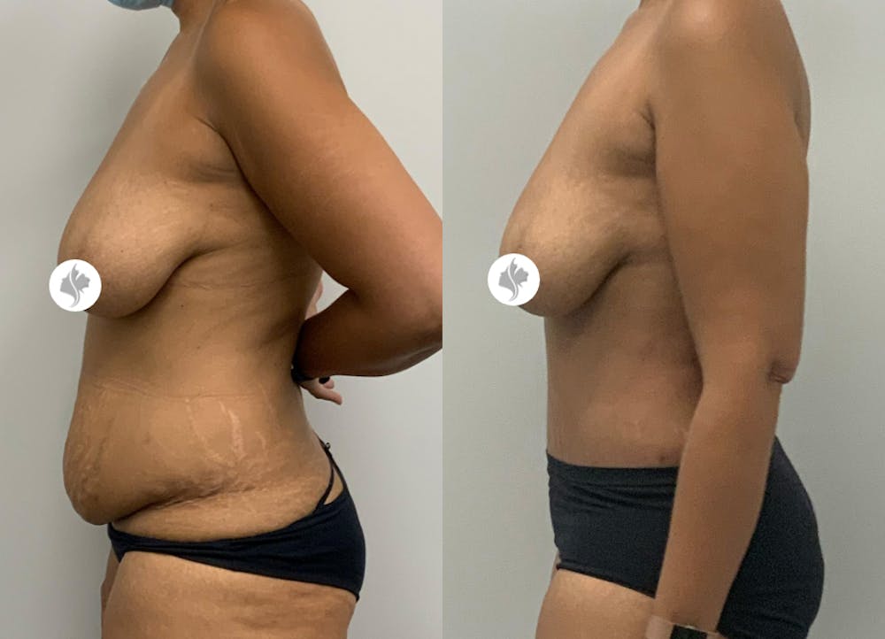 This is one of our beautiful tummy tuck patient #15