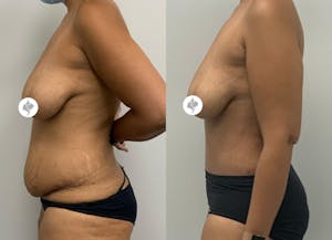 This is one of our beautiful tummy tuck patient 15