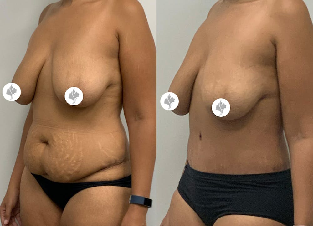 This is one of our beautiful tummy tuck patient #15