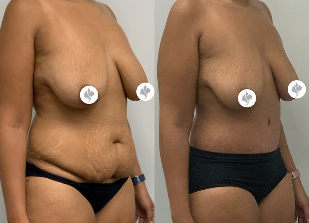 This is one of our beautiful tummy tuck patient #15
