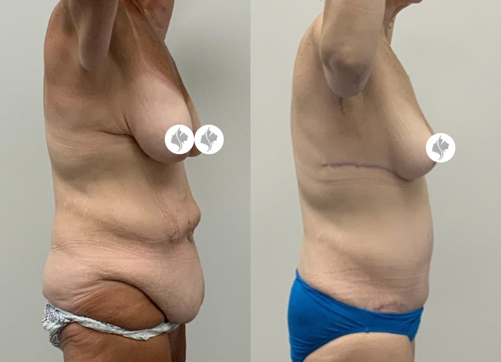This is one of our beautiful post-bariatric body contouring patient #9