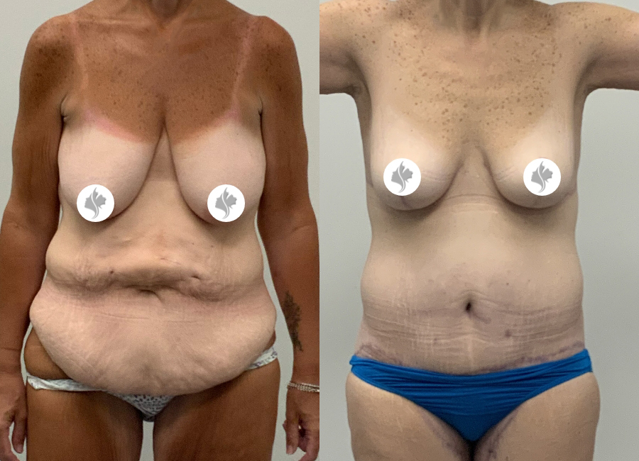 This is one of our beautiful tummy tuck patient 11