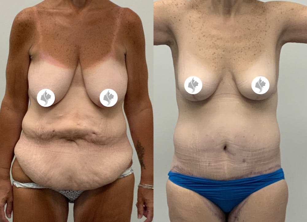 This is one of our beautiful post-bariatric body contouring patient #9
