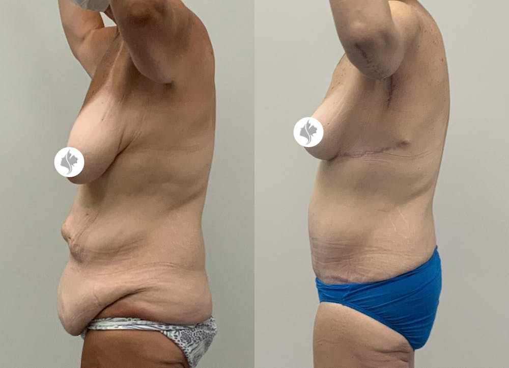 This is one of our beautiful post-bariatric body contouring patient #9