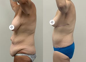 This is one of our beautiful tummy tuck patient 4