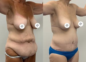 This is one of our beautiful post-bariatric body contouring patient 9
