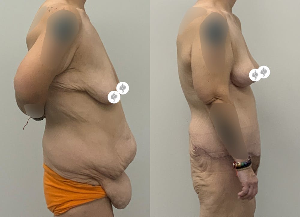 This is one of our beautiful tummy tuck patient #21