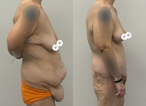 This is one of our beautiful tummy tuck patient 16