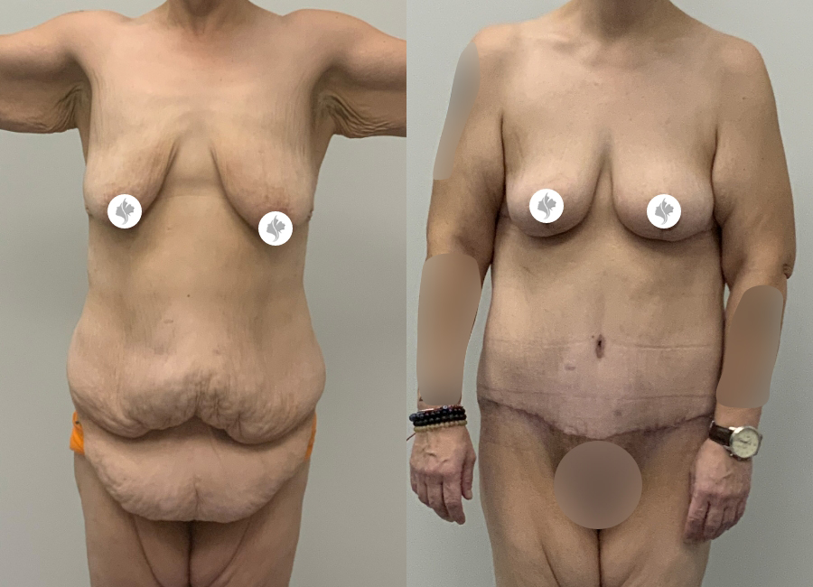 This is one of our beautiful tummy tuck patient 21