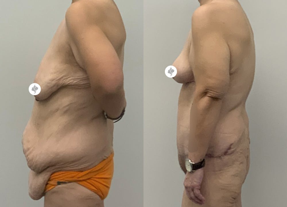 This is one of our beautiful tummy tuck patient #16