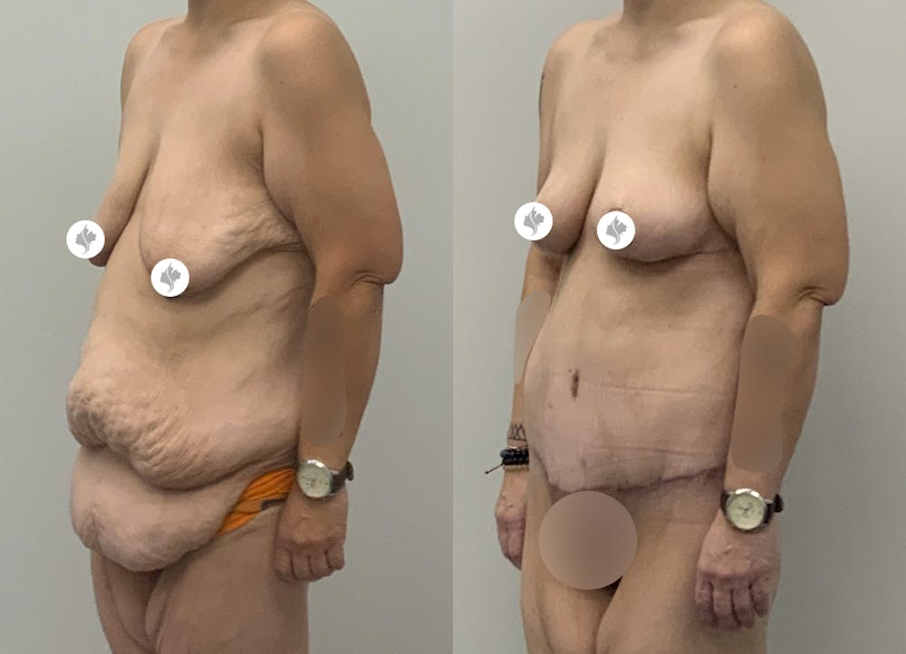 This is one of our beautiful tummy tuck patient #16