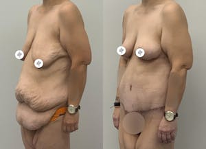 This is one of our beautiful tummy tuck patient 16