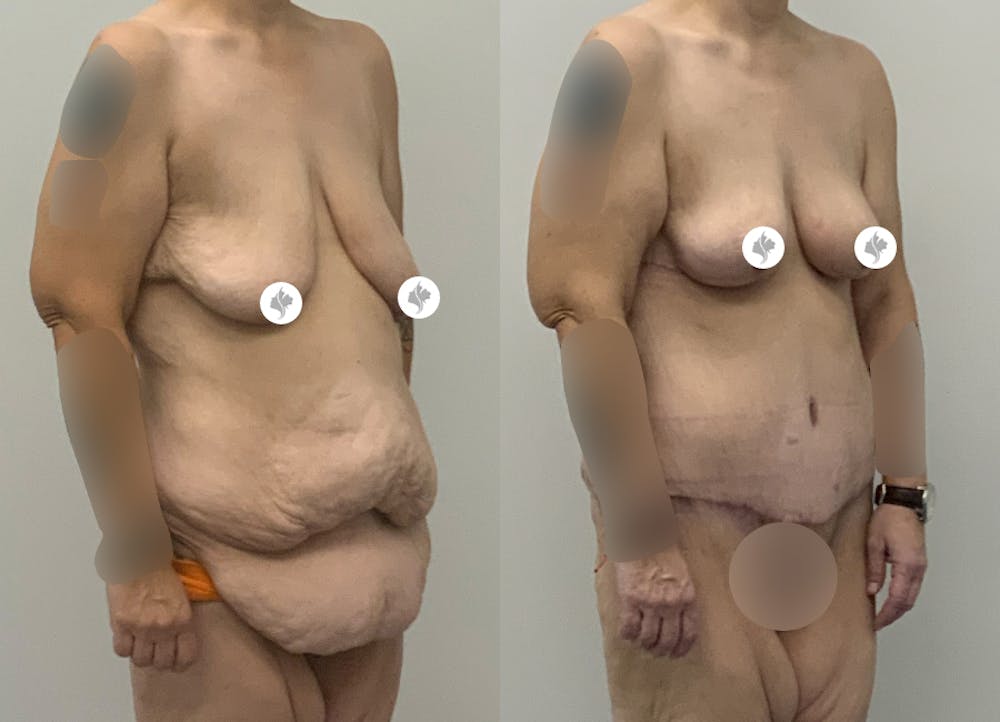 This is one of our beautiful tummy tuck patient #16