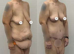 This is one of our beautiful tummy tuck patient 16