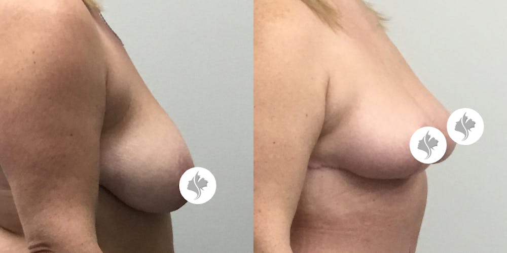 This is one of our beautiful breast reduction patient #1