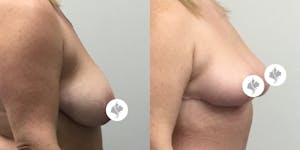 This is one of our beautiful breast reduction patient 1